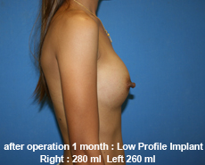 plastic-surgery-breast-augmentation